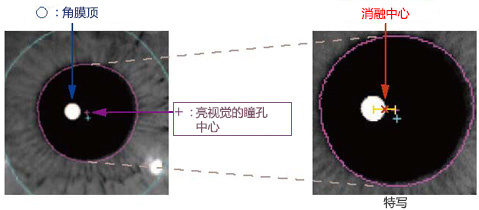 Eye Tracking Offset to move ablation center